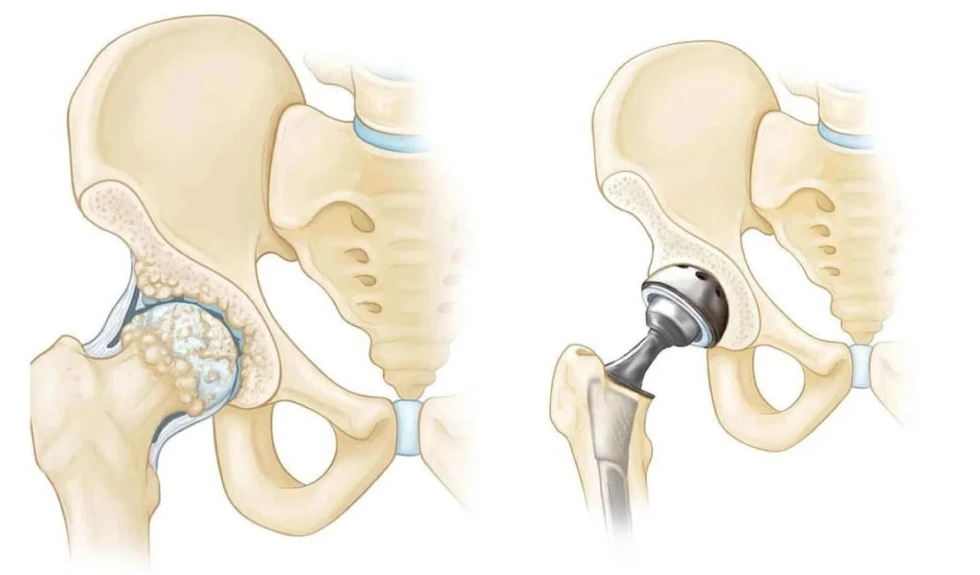 Complete Guide to Recovery After Total Hip Replacement Surgery in Delhi