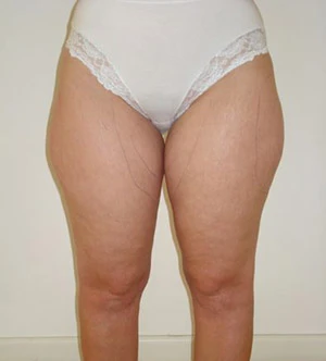 💫Reclaim Your Waistline: Expert Tummy Tuck Harley Street London & Abdominoplasty London at Harley St. Aesthetics