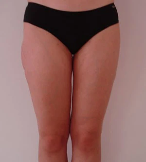 💫Reclaim Your Waistline: Expert Tummy Tuck Harley Street London & Abdominoplasty London at Harley St. Aesthetics