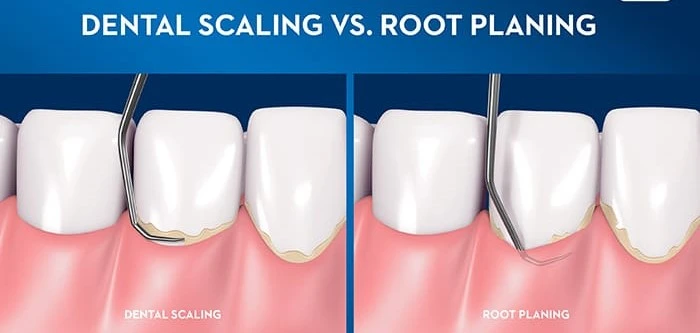 What to Expect After a Scaling and Root Planing Procedure ?