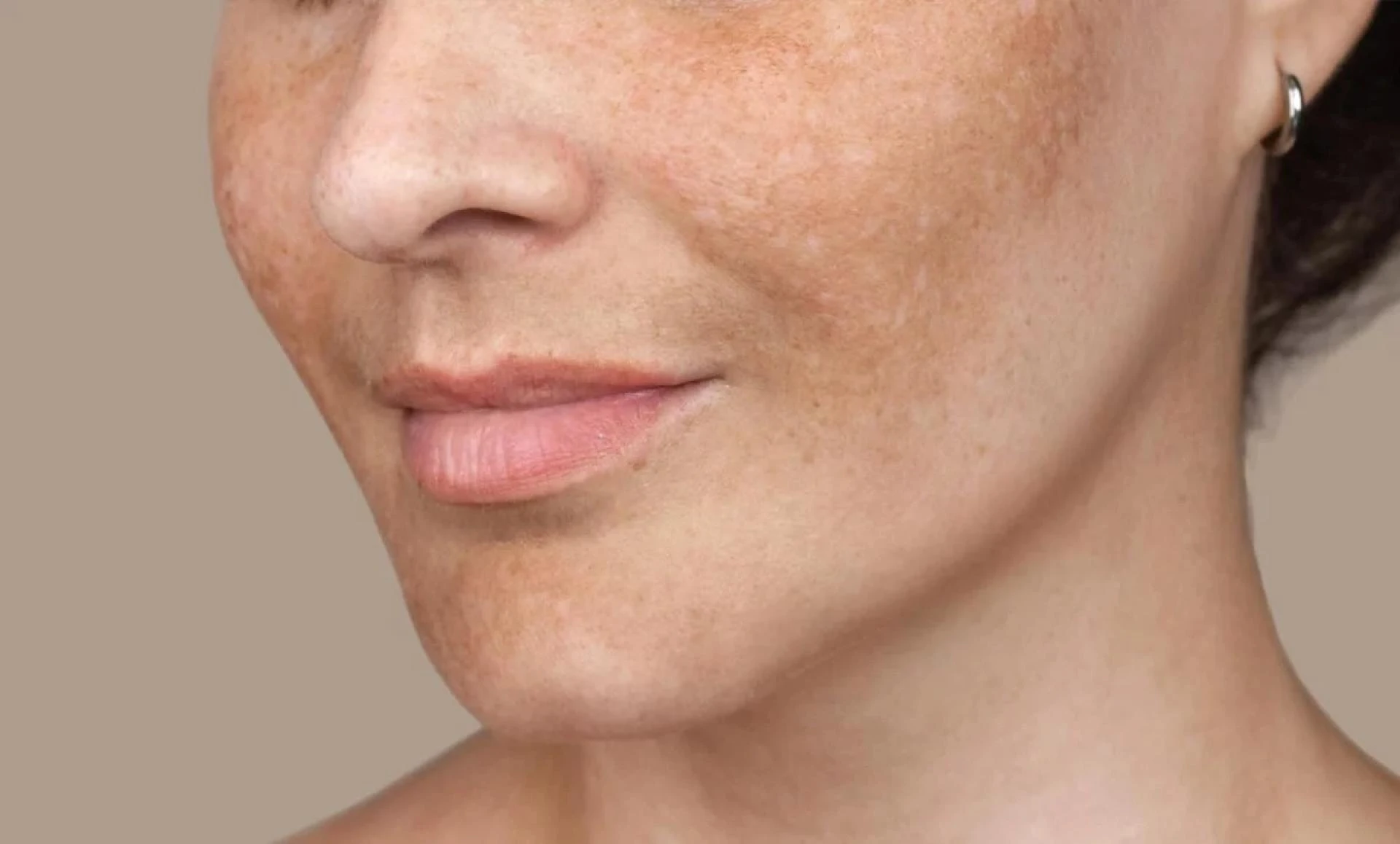 Effective Pigmentation Treatment in Delhi: How to Get the Best, Long-Lasting Results