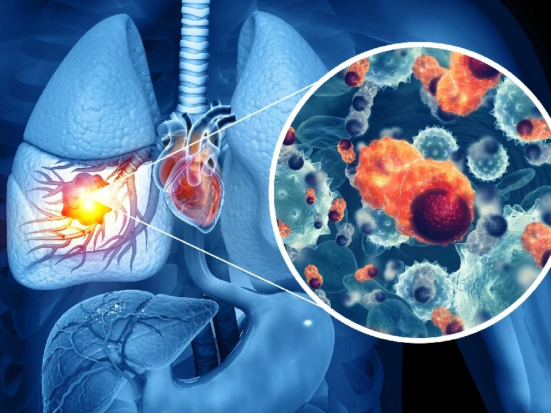 Immunotherapy: A Groundbreaking Approach in the Fight Against Cancer