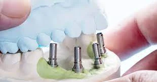 Are Dental Implants Painful?