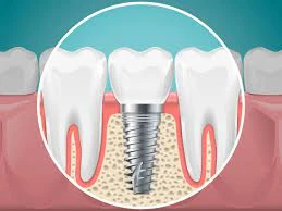 Are Dental Implants Right for Seniors?