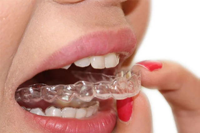Do Smilers Clear Aligners Really Work?