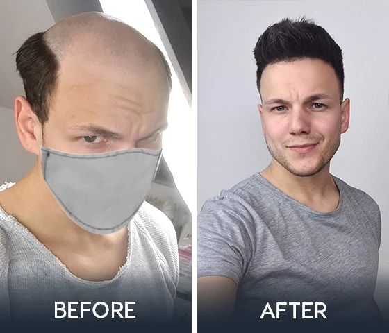 Why Shouldn't Men Wear Hairpieces Too?