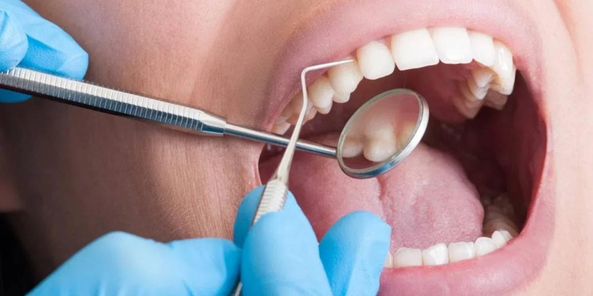 Signs You May Need Periodontal Treatment Immediately