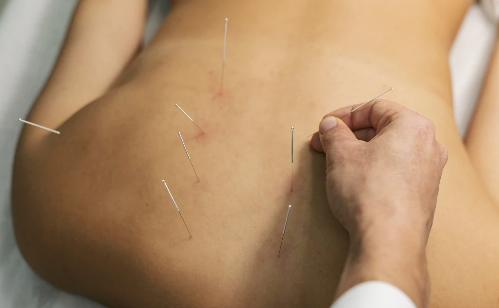 Find Trusted Acupuncture Near Me for Pain Relief and Wellness Today