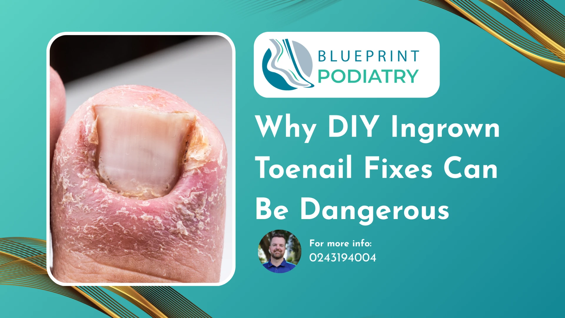 Why DIY Ingrown Toenail Fixes Can Be Dangerous