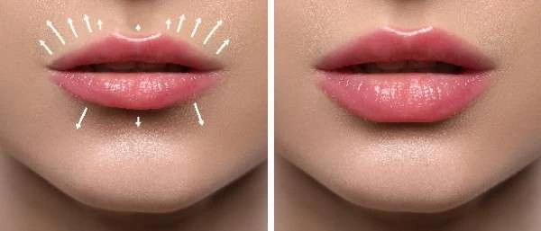 What to Expect at Your First Lip Filler Appointment