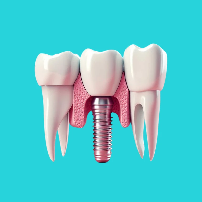 Key facts to know before getting dental implants in Miami