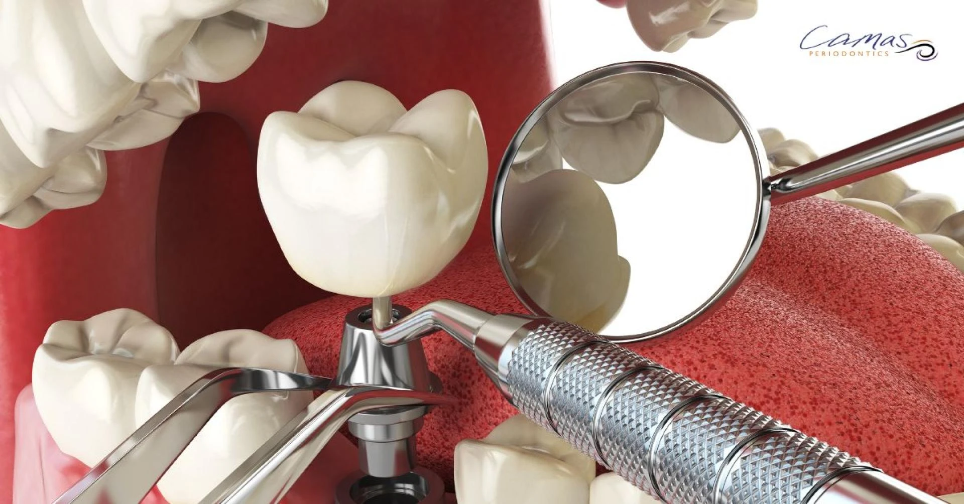 How Dental Implants Can Improve Your Smile and Confidence ?