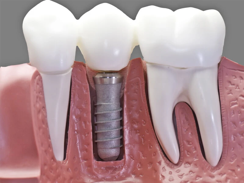 How Dental Implants Can Improve Your Smile and Confidence ?