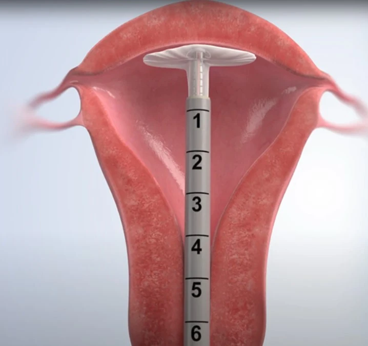 Cerena Endometrial Ablation in the Office: A Modern Solution for Heavy Uterine Bleeding