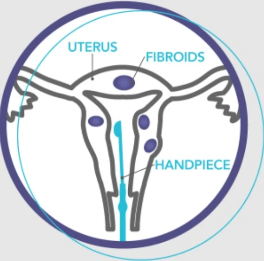 Minimally Invasive Sonata Treatment of Fibroids in Bucks County – A New Era in Women’s Health Understanding Uterine Fibroids and Their Impact