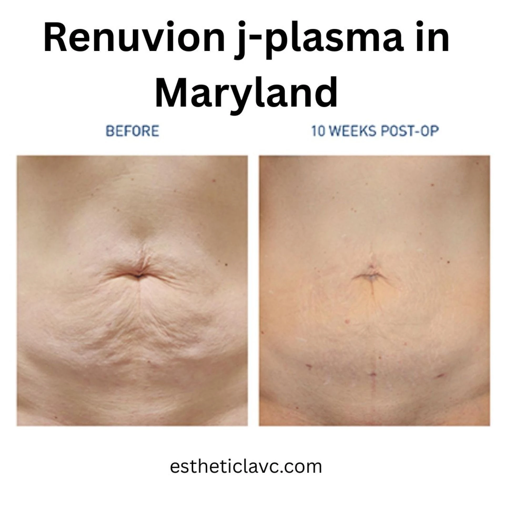 Renuvion J-Plasma vs Traditional Skin Tightening: Maryland Experts Explain