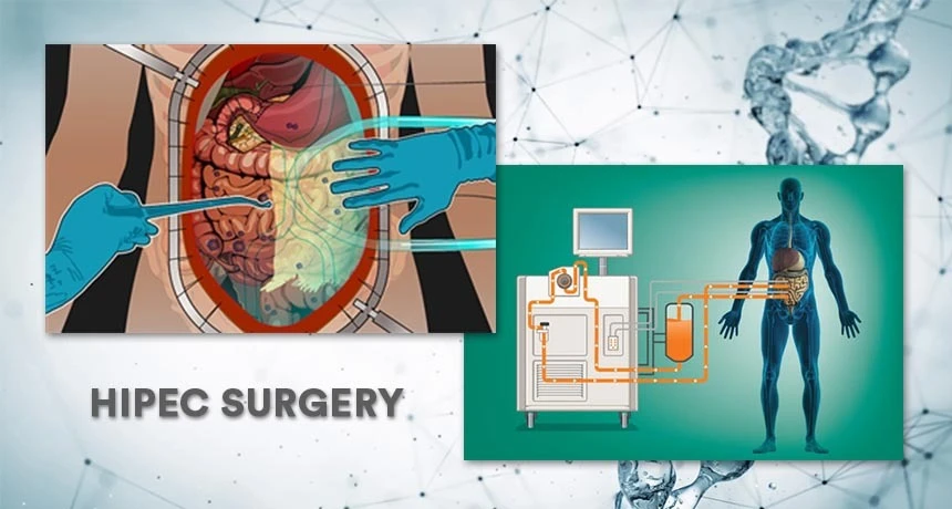 Advanced GI Cancer Care with HIPEC – Insights from a Leading HIPEC Surgeon in Delhi