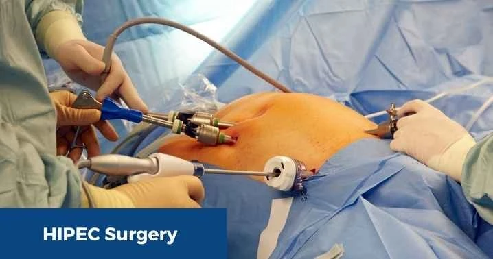 Advanced GI Cancer Care with HIPEC – Insights from a Leading HIPEC Surgeon in Delhi