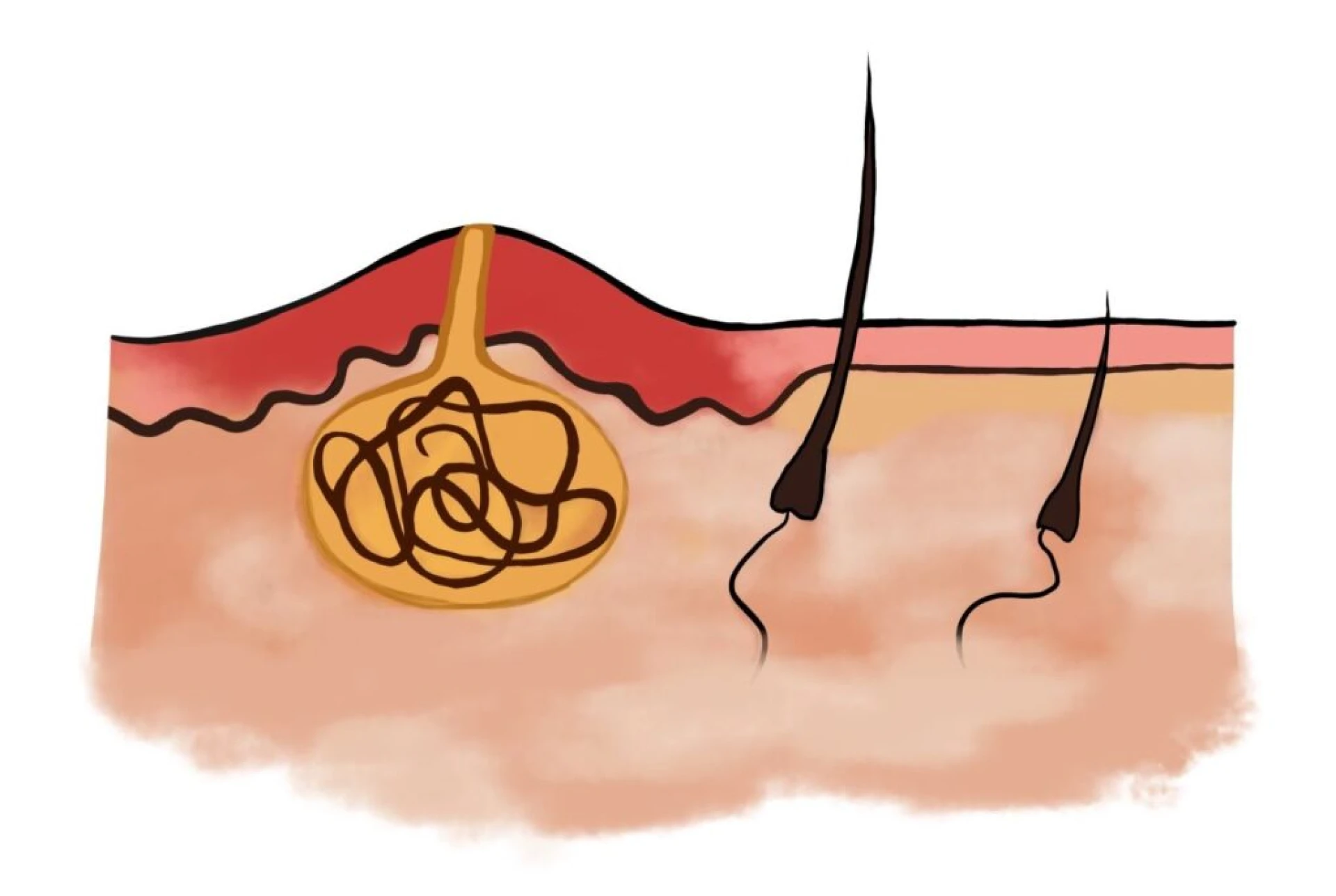 Best Treatment for Pilonidal Sinus in India: Why Choose Homeopathy