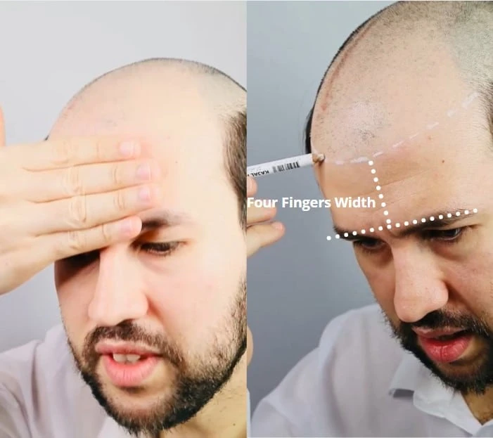 When Hair Systems Go Wrong: The Worst Stories (and How to Avoid Them)