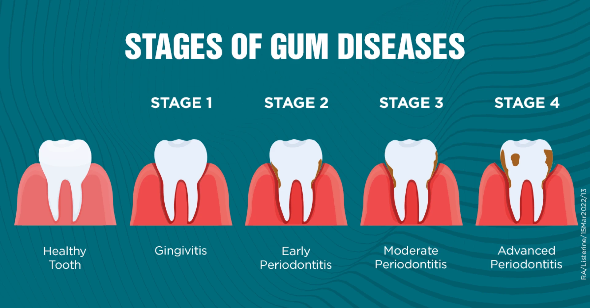 What Is Periodontal Disease Treatment ?