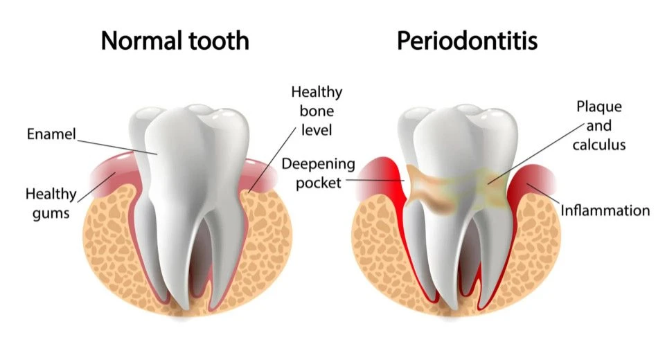 What Is Periodontal Disease Treatment ?