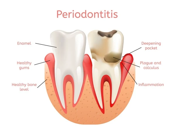What Is Periodontal Disease Treatment ?