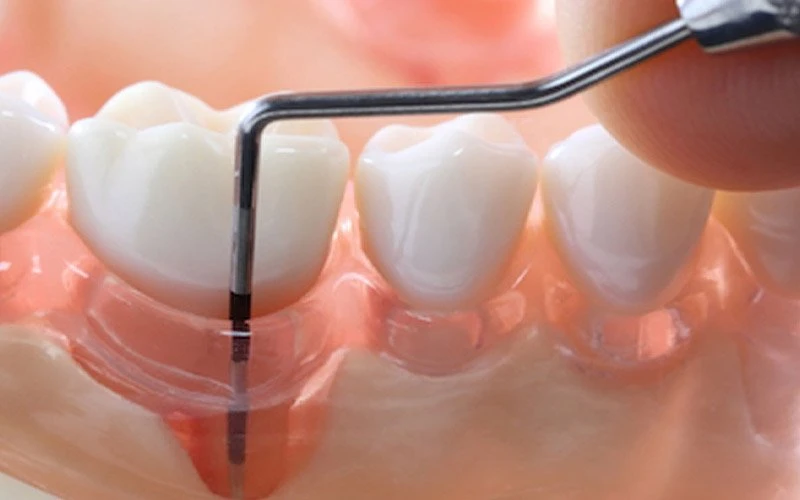 What Is Periodontal Disease Treatment ?