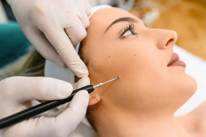 Skin Tag and Wart Removal: Safe and Effective Methods