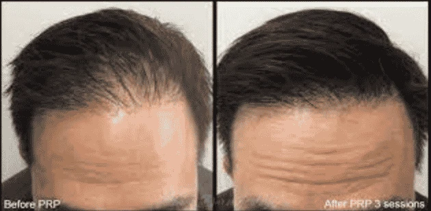 How PRP Therapy is Revolutionizing Hair Loss Treatment in NYC