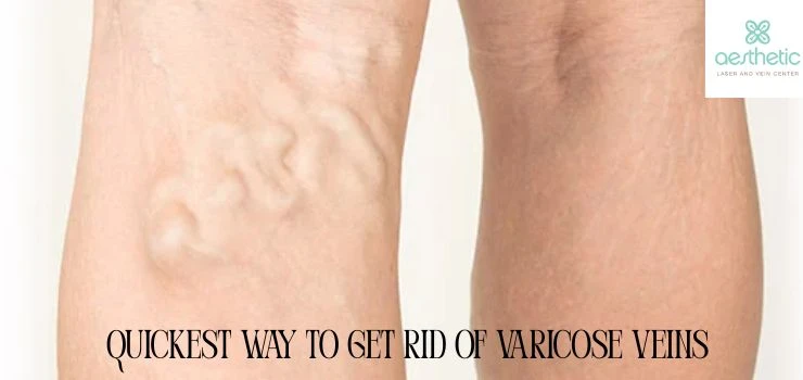 What to Expect at Your First Varicose Vein Consultation in Maryland?