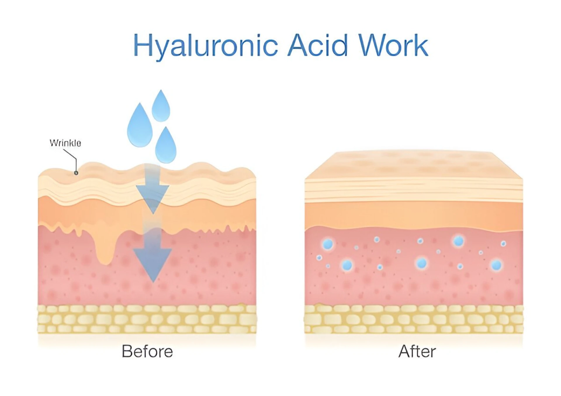 What are Hyaluronic Acid (HA) Fillers?