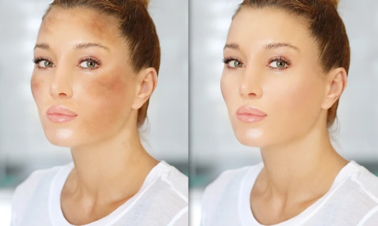 Effective Melasma Treatment in Arlington at Lumina Laser Beauty