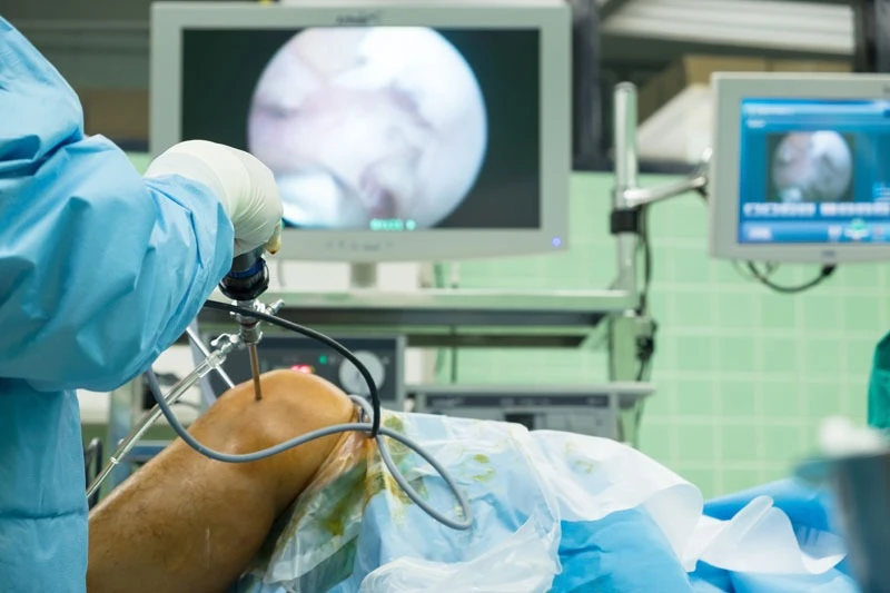 Arthroscopic Surgery In Delhi : Purpose, Procedure, Benefits, Cost & Recovery