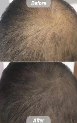 Hair Regrowth, Laser Hair Loss Treatment & Technology