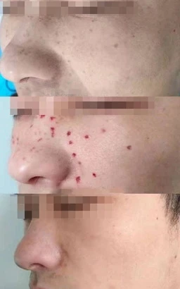 Tattoo and Pigmentation Removal Treatment Solution with Picosecond Laser Technology