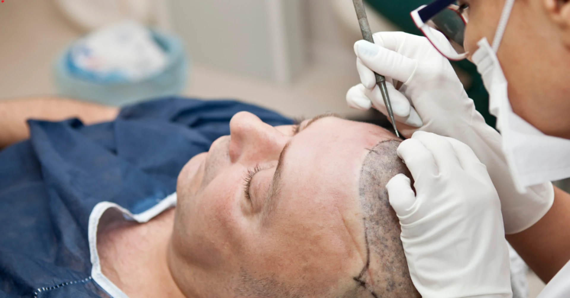 hair transplant