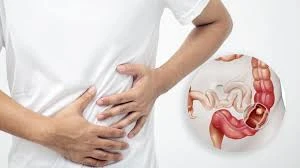 Under Age 50? Take Steps Now to Prevent Colon Cancer