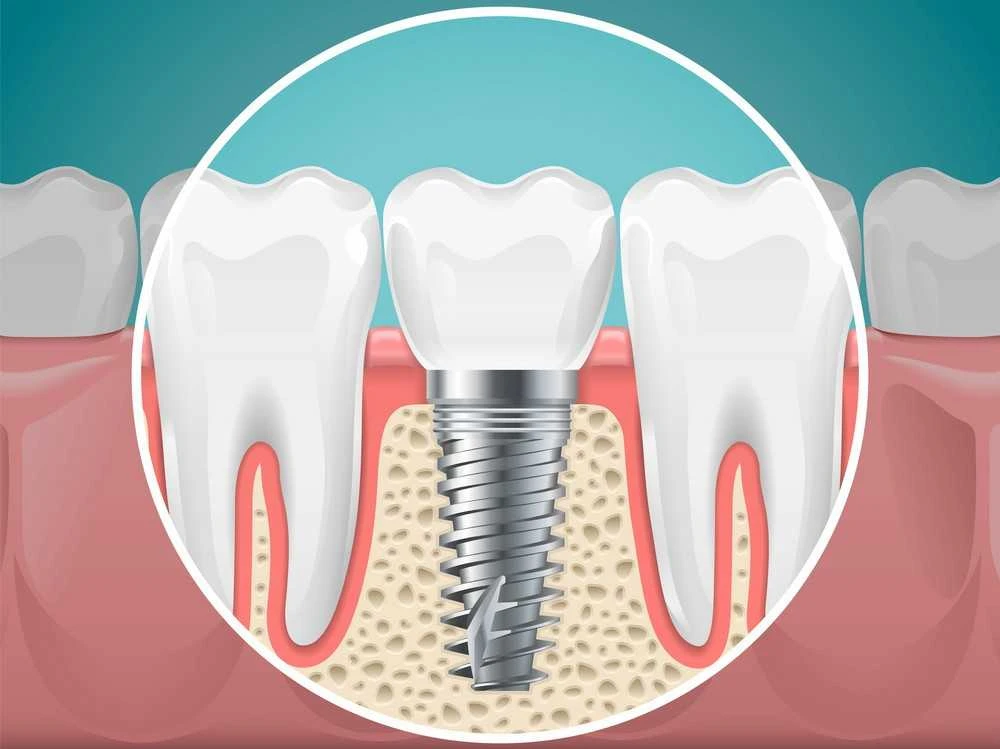 How Dental Implants Improve Confidence and Quality of Life ?