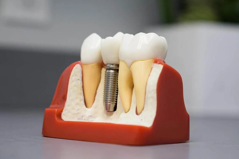 How Dental Implants Improve Confidence and Quality of Life ?