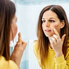 When to See a Doctor For Acne Breakouts?