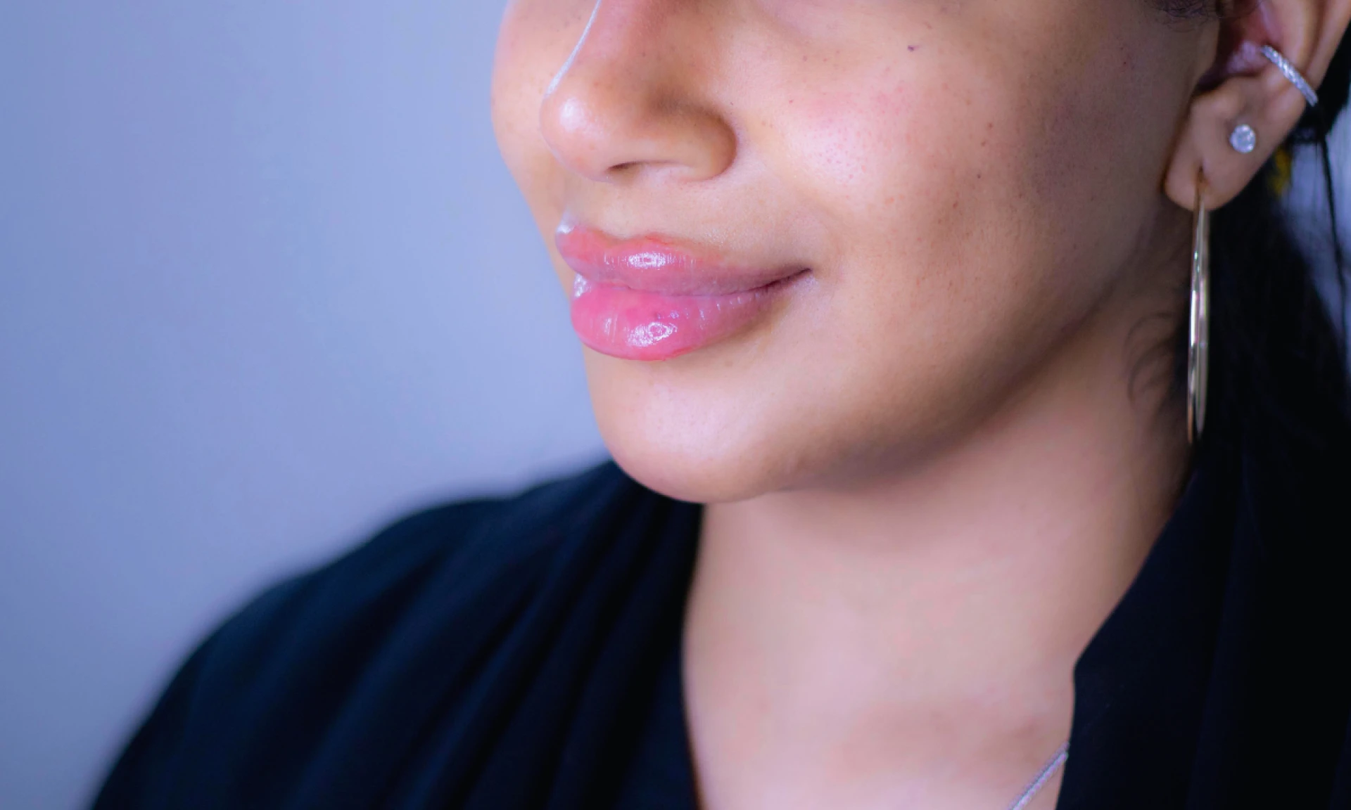 Title: Redefining Beauty Gracefully with Lip Fillers