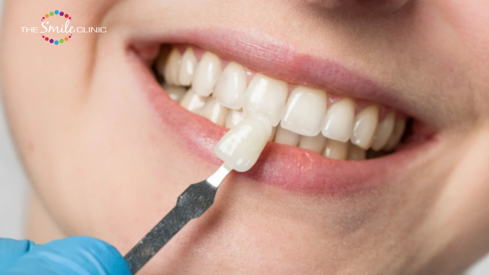 Porcelain Veneers: A Confident Smile Starts with the Right Dental Clinic