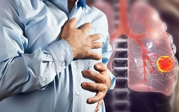Understanding Lung Cancer: Causes, Symptoms, and Treatment Options