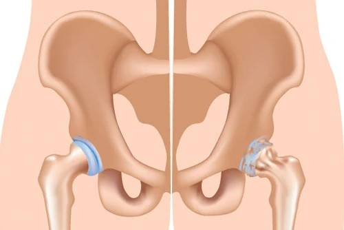 The Future of Hip Surgery: Direct Anterior Approach for Total Hip Replacement in Delhi