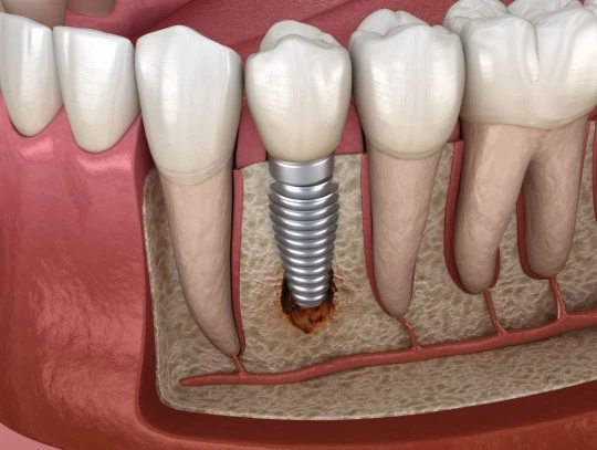 What Are the Benefits of Dental Implants in Dubai?