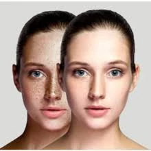 Melasma Causes in Women: Understanding the Hormonal Triggers