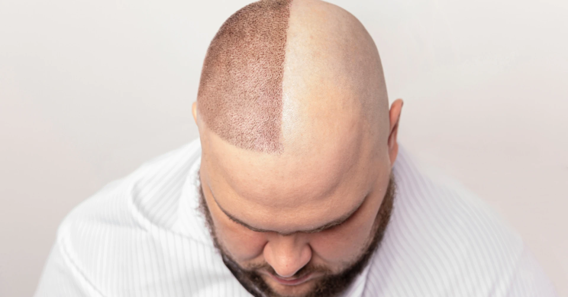 Hair Transplant