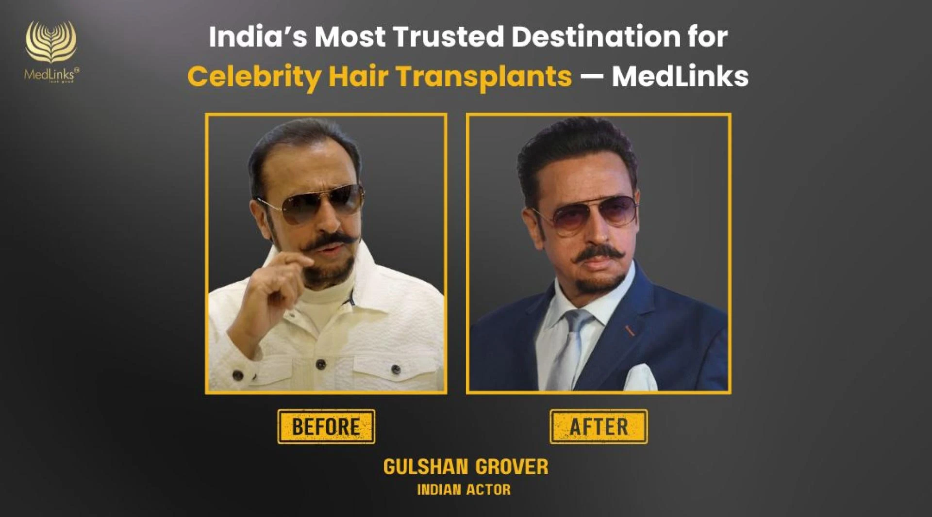 FUE Hair Transplant Cost in India at MedLinks Hair Transplant Clinic.