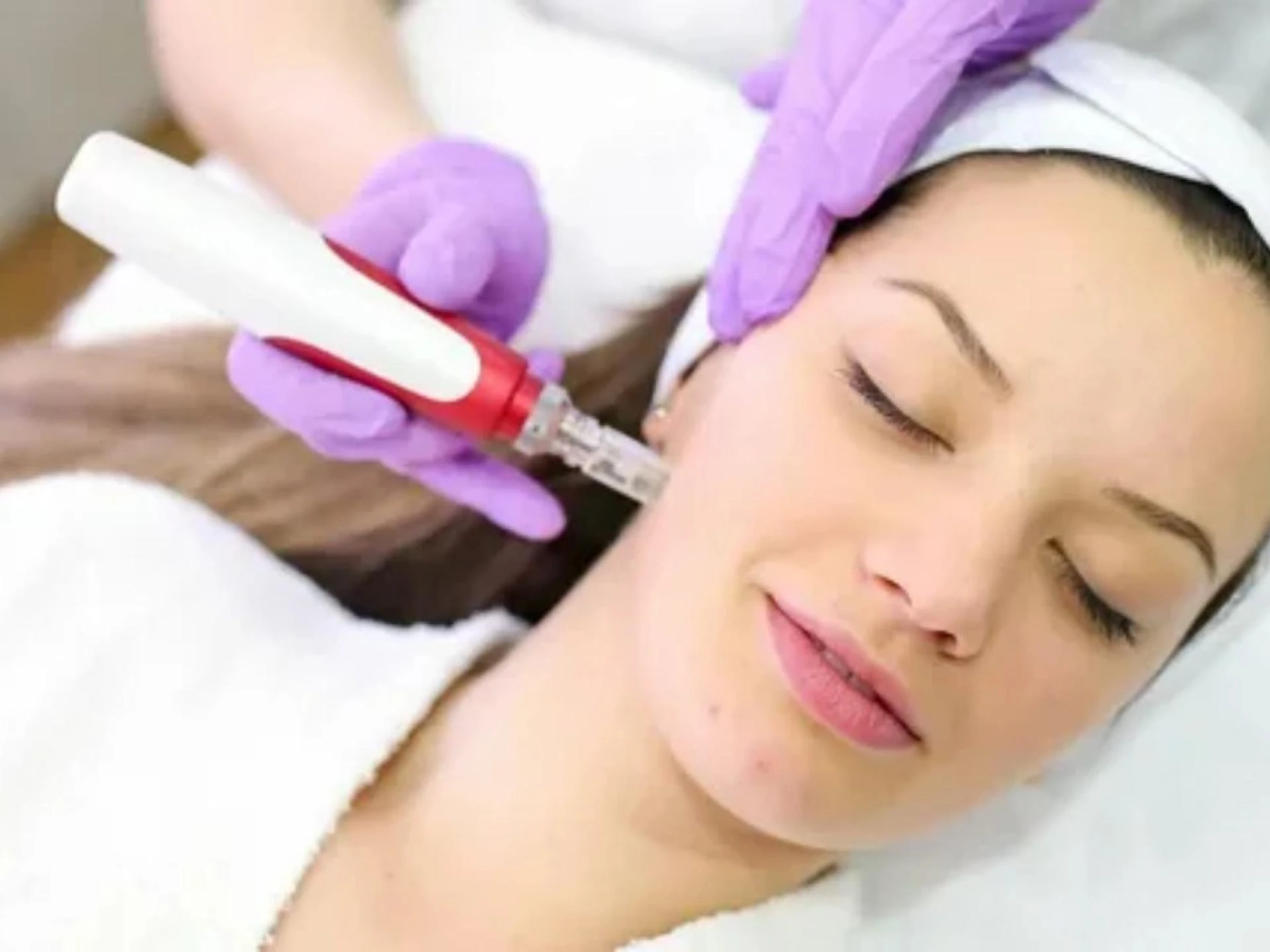 Why Microneedling Is the Secret to Youthful Skin in Palm Beach